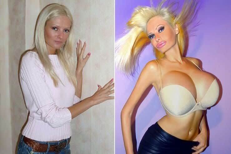 30+ Shocking Transformations: People Who Took Plastic Surgery to the Next Level